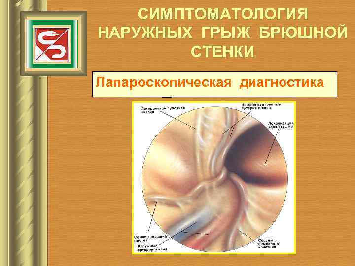 СИМПТОМАТОЛОГИЯ НАРУЖНЫХ ГРЫЖ БРЮШНОЙ СТЕНКИ Лапароскопическая диагностика 