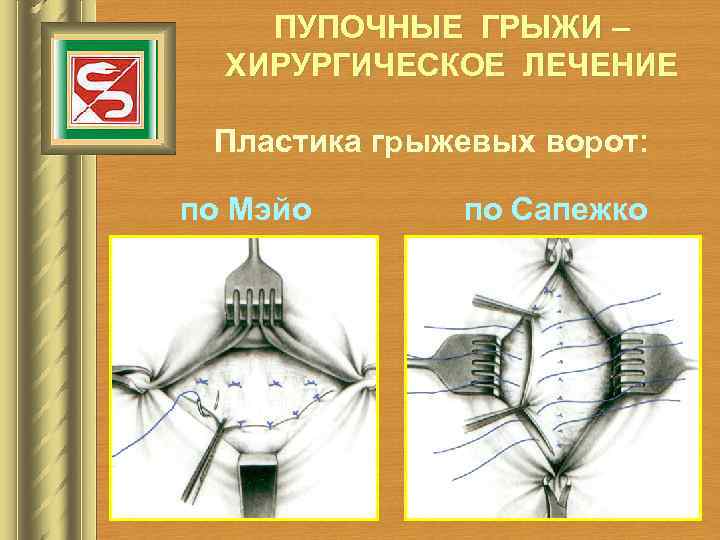 ПУПОЧНЫЕ ГРЫЖИ – ХИРУРГИЧЕСКОЕ ЛЕЧЕНИЕ Пластика грыжевых ворот: по Мэйо по Сапежко 