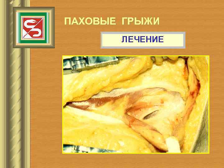 ПАХОВЫЕ ГРЫЖИ ЛЕЧЕНИЕ 