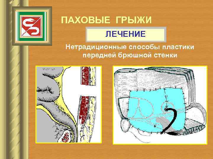 ПАХОВЫЕ ГРЫЖИ ЛЕЧЕНИЕ Нетрадиционные способы пластики передней брюшной стенки 