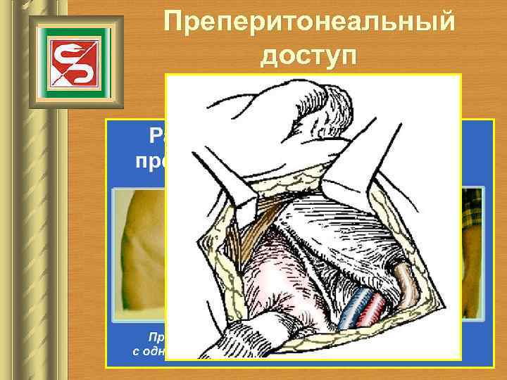 Преперитонеальный доступ 