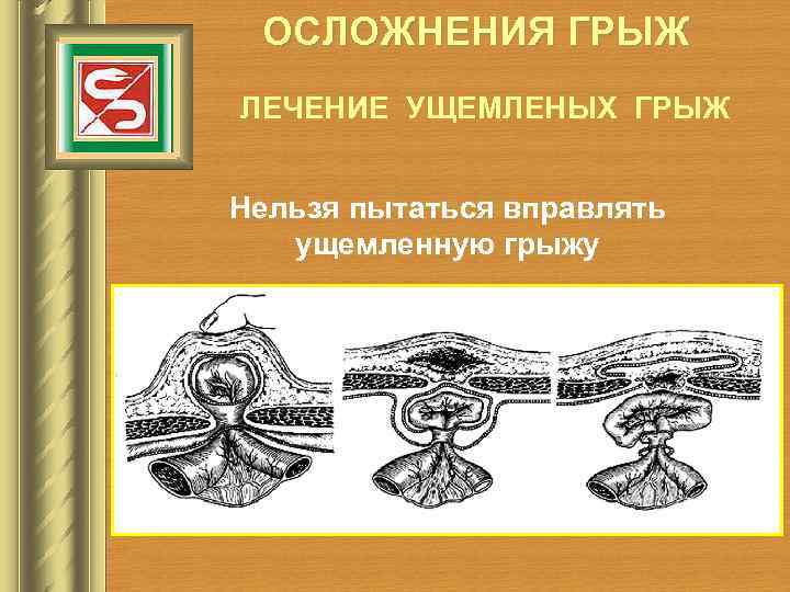 ОСЛОЖНЕНИЯ ГРЫЖ ЛЕЧЕНИЕ УЩЕМЛЕНЫХ ГРЫЖ Нельзя пытаться вправлять ущемленную грыжу 