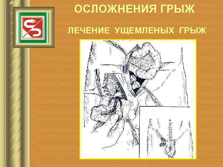 ОСЛОЖНЕНИЯ ГРЫЖ ЛЕЧЕНИЕ УЩЕМЛЕНЫХ ГРЫЖ 