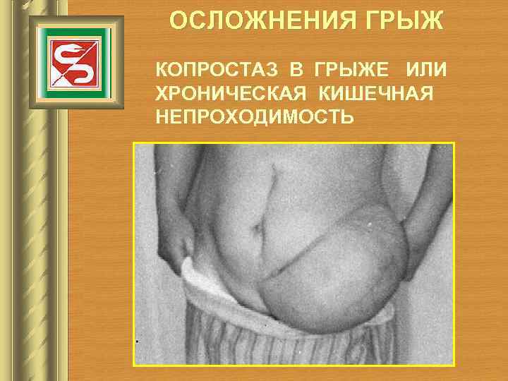 ОСЛОЖНЕНИЯ ГРЫЖ КОПРОСТАЗ В ГРЫЖЕ ИЛИ ХРОНИЧЕСКАЯ КИШЕЧНАЯ НЕПРОХОДИМОСТЬ 