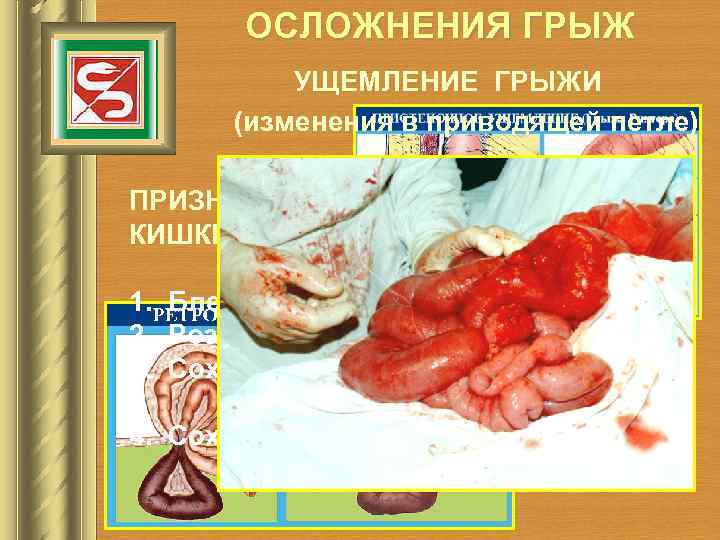 ОСЛОЖНЕНИЯ ГРЫЖ УЩЕМЛЕНИЕ ГРЫЖИ (изменения в приводящей петле) ПРИЗНАКА ЖИЗНЕСПОСОБНОСТИ КИШКИ: 1. Блестящая серозная