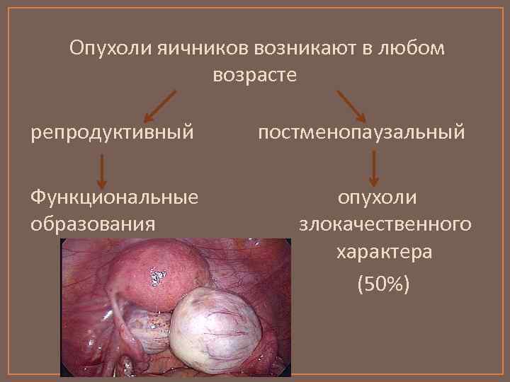 Опухоли яичников возникают в любом возрасте репродуктивный постменопаузальный Функциональные образования опухоли злокачественного характера (50%)