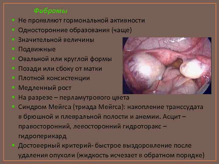 Фибромы Не проявляют гормональной активности Односторонние образования (чаще) Значительной величины Подвижные Овальной или круглой