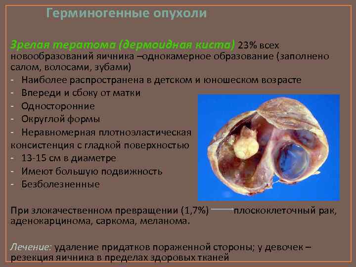 Герминогенные опухоли Зрелая тератома (дермоидная киста) 23% всех новообразований яичника –однокамерное образование (заполнено салом,