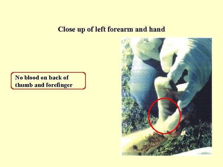 Close up of left forearm and hand No blood on back of thumb and