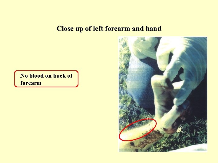 Close up of left forearm and hand No blood on back of forearm 