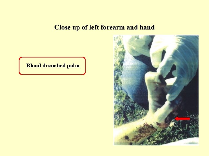 Close up of left forearm and hand Blood drenched palm 