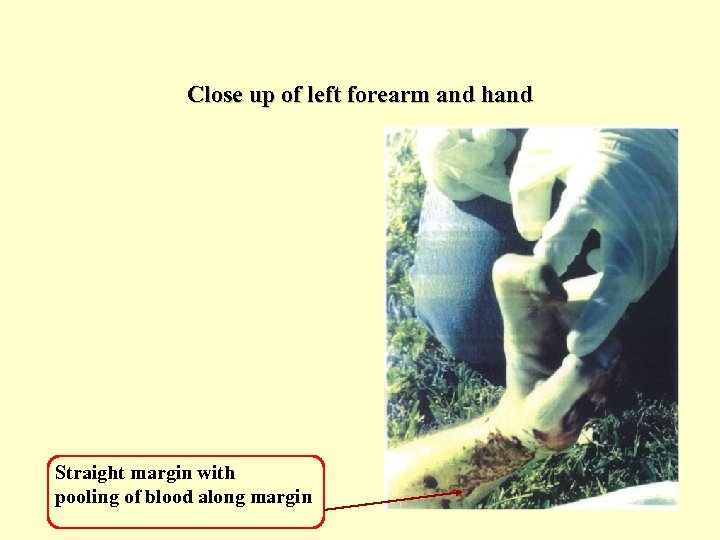 Close up of left forearm and hand Straight margin with pooling of blood along