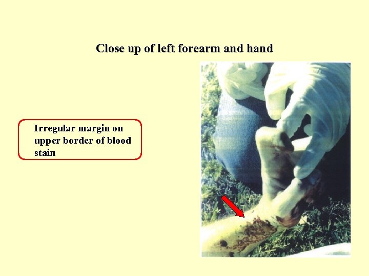 Close up of left forearm and hand Irregular margin on upper border of blood