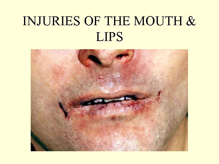 INJURIES OF THE MOUTH & LIPS 