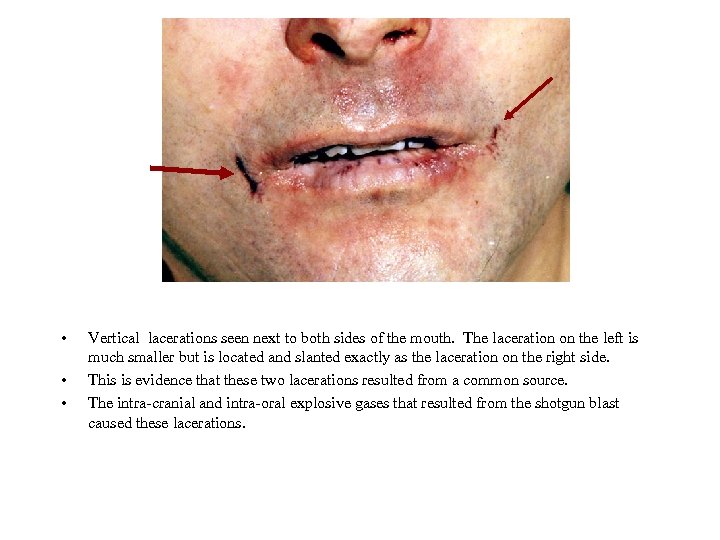  • • • Vertical lacerations seen next to both sides of the mouth.