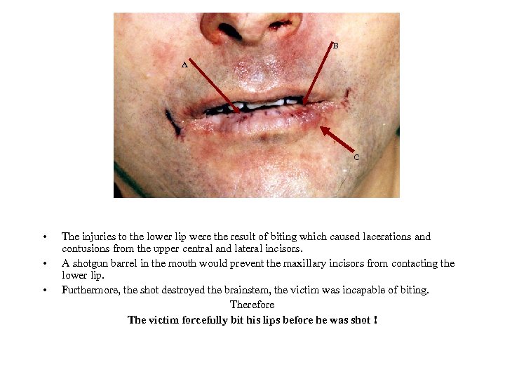 B A C • • • The injuries to the lower lip were the