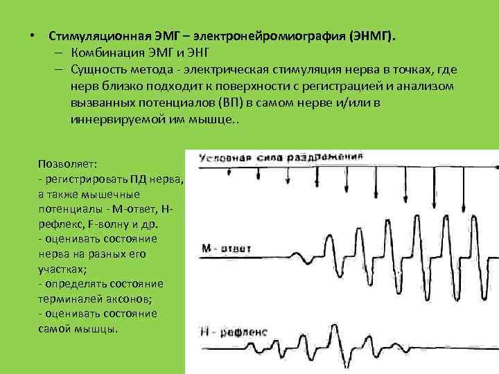  • Стимуляционная ЭМГ – электронейромиография (ЭНМГ). – Комбинация ЭМГ и ЭНГ – Сущность