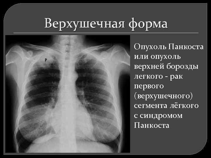 Верхушечная форма Опухоль Панкоста или опухоль верхней борозды легкого - рак первого (верхушечного) сегмента