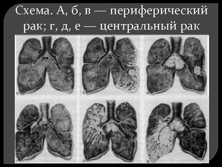 Схема. А, б, в — периферический рак; г, д, е — центральный рак 