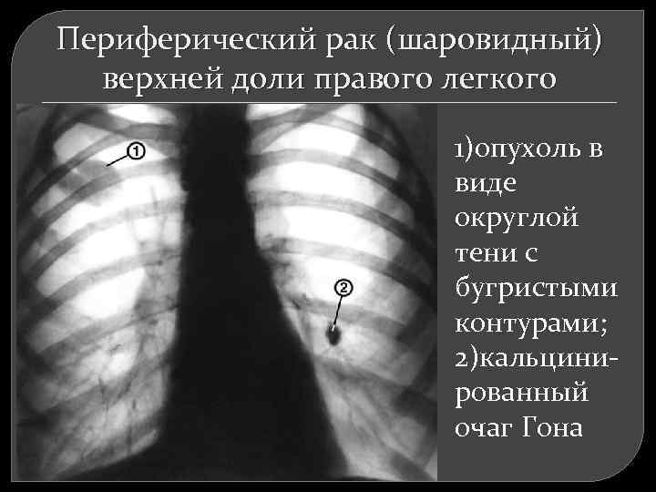 Периферический рак (шаровидный) верхней доли правого легкого 1)опухоль в виде округлой тени с бугристыми