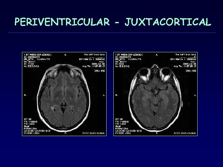 PERIVENTRICULAR - JUXTACORTICAL 