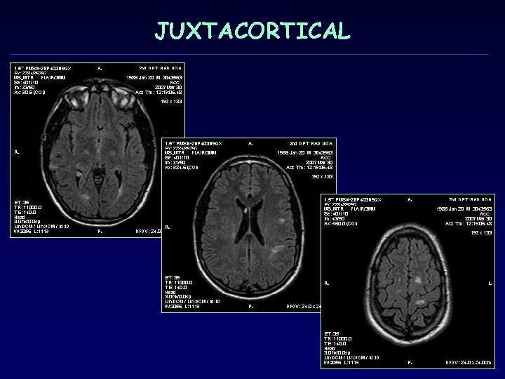 JUXTACORTICAL 