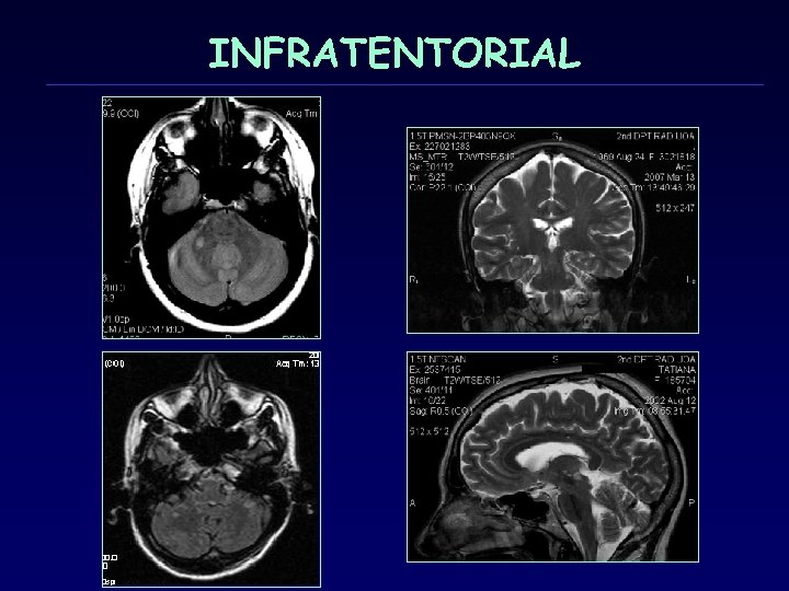 INFRATENTORIAL 