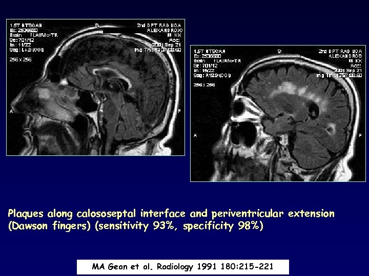 Plaques along calososeptal interface and periventricular extension (Dawson fingers) (sensitivity 93%, specificity 98%) MA