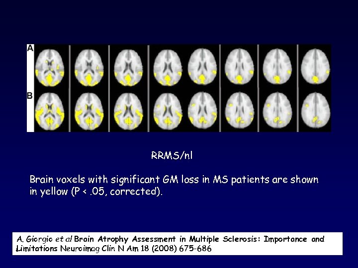 RRMS/nl Brain voxels with significant GM loss in MS patients are shown in yellow