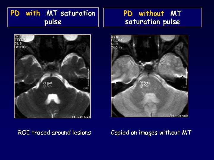 PD with MT saturation pulse PD without MT saturation pulse ROI traced around lesions