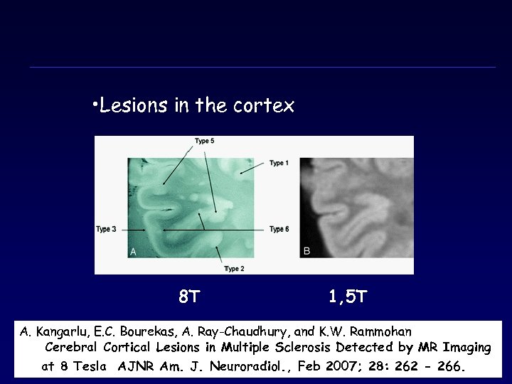  • Lesions in the cortex 8Τ 1, 5Τ A. Kangarlu, E. C. Bourekas,