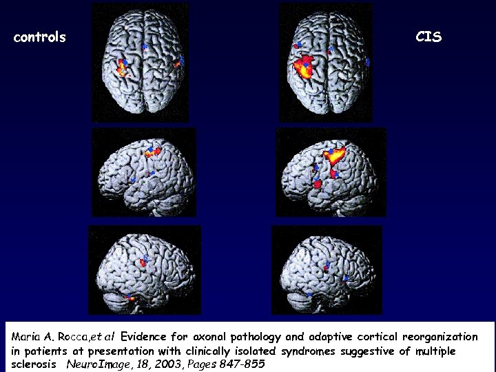 controls CIS Maria A. Rocca, et al Evidence for axonal pathology and adaptive cortical