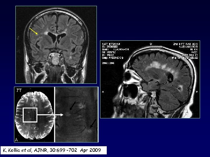 K. Kollia et al, AJNR, 30: 699 – 702 Apr 2009 