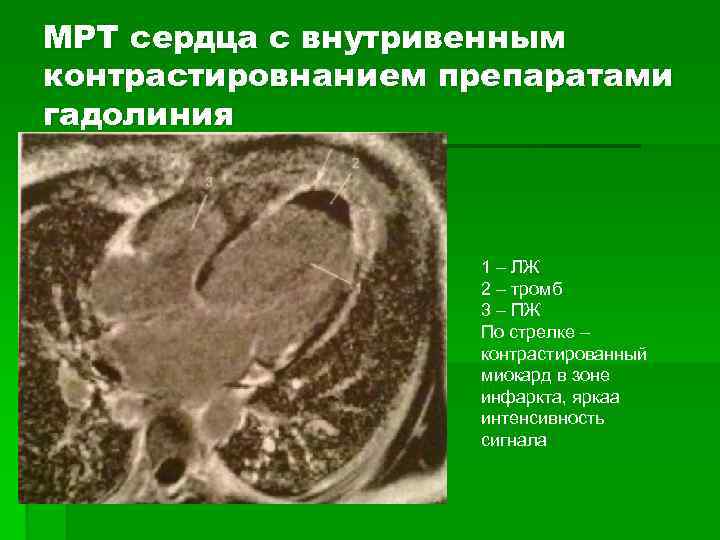 МРТ сердца с внутривенным контрастировнанием препаратами гадолиния 1 – ЛЖ 2 – тромб 3