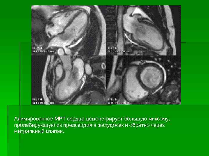 Анимированное МРТ сердца демонстрирует большую миксому, пролабирующую из предсердия в желудочек и обратно через