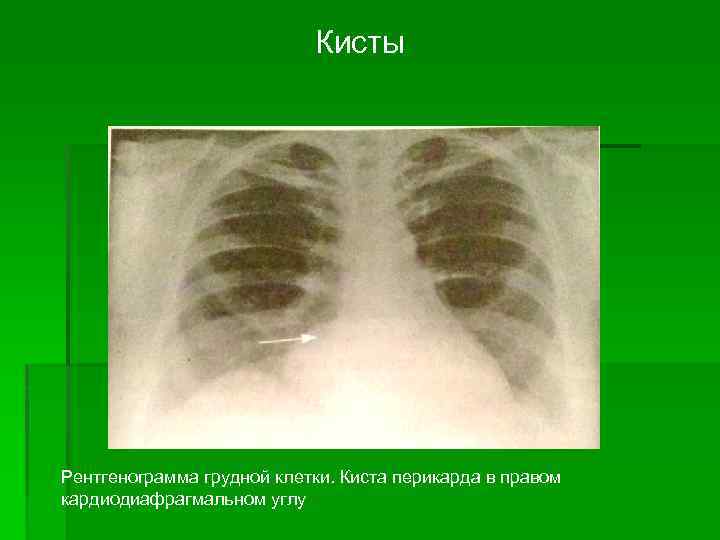 Кисты Рентгенограмма грудной клетки. Киста перикарда в правом кардиодиафрагмальном углу 