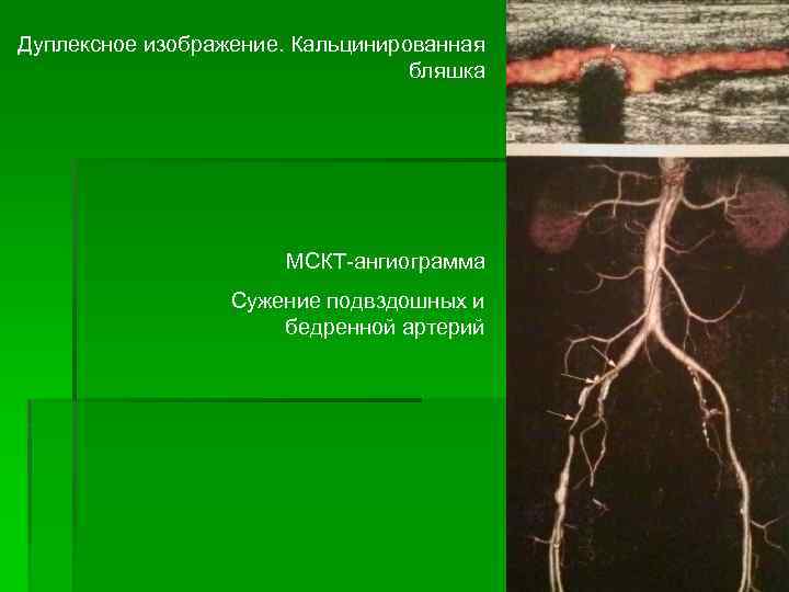 Дуплексное изображение. Кальцинированная бляшка МСКТ-ангиограмма Сужение подвздошных и бедренной артерий 