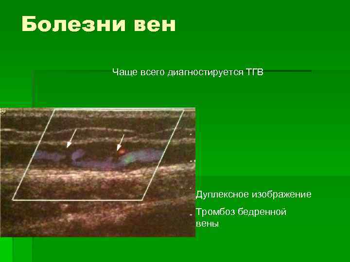 Болезни вен Чаще всего диагностируется ТГВ Дуплексное изображение Тромбоз бедренной вены 