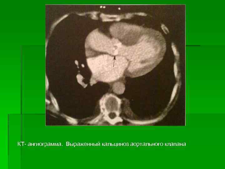 КТ- ангиограмма. Выраженный кальциноз аортального клапана 