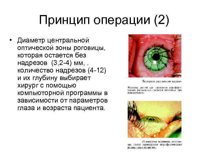 Принцип операции (2) • Диаметр центральной оптической зоны роговицы, которая остается без надрезов (3,