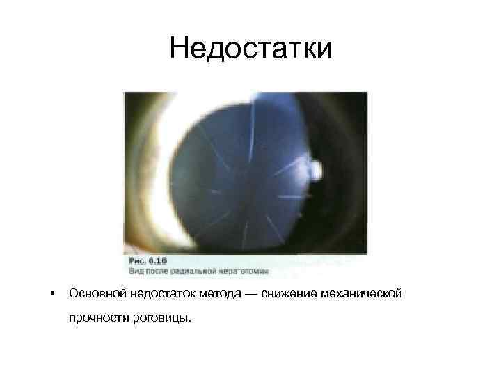 Недостатки • Основной недостаток метода — снижение механической прочности роговицы. 