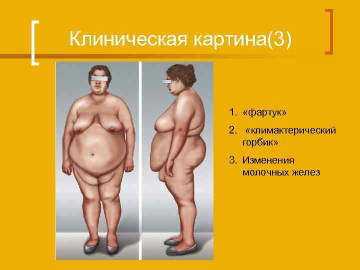 Клиническая картина(3) 1. «фартук» 2. «климактерический горбик» 3. Изменения молочных желез 