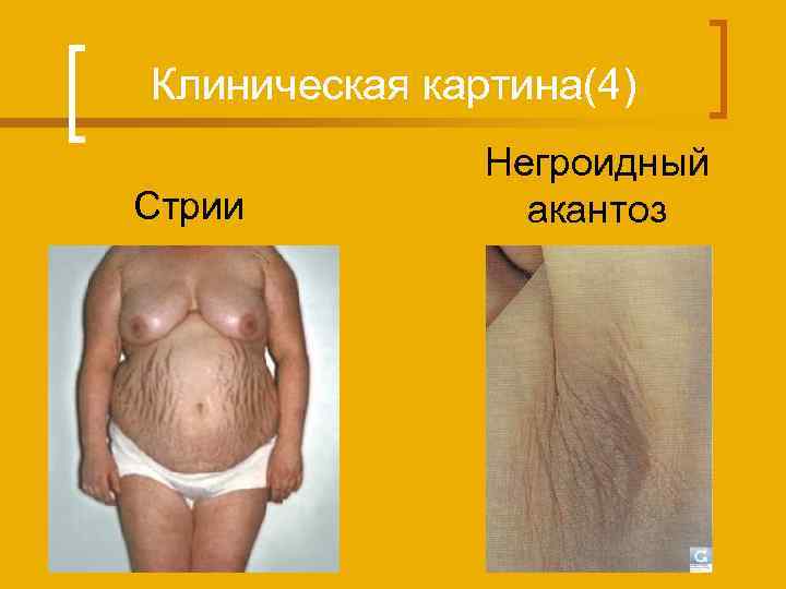 Клиническая картина(4) Стрии Негроидный акантоз 