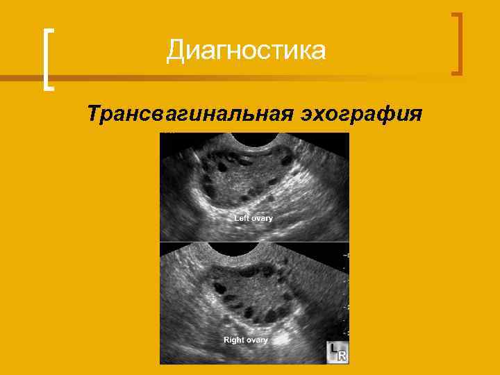 Диагностика Трансвагинальная эхография 