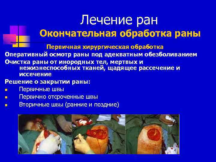 Лечение ран Окончательная обработка раны Первичная хирургическая обработка Оперативный осмотр раны под адекватным обезболиванием