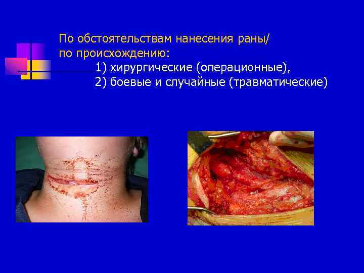 По обстоятельствам нанесения раны/ по происхождению: 1) хирургические (операционные), 2) боевые и случайные (травматические)