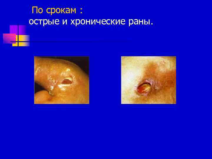 По срокам : острые и хронические раны. 