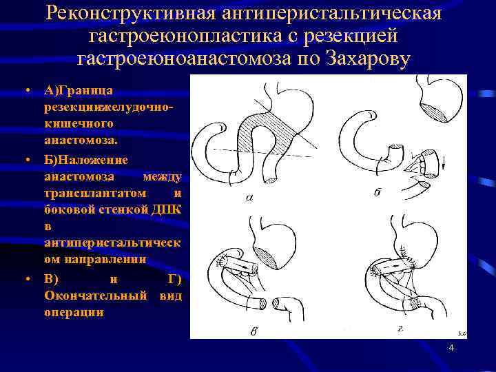 Резекция желудка по витебскому схема операции