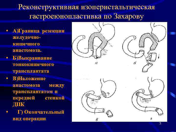 Резекция желудка схема