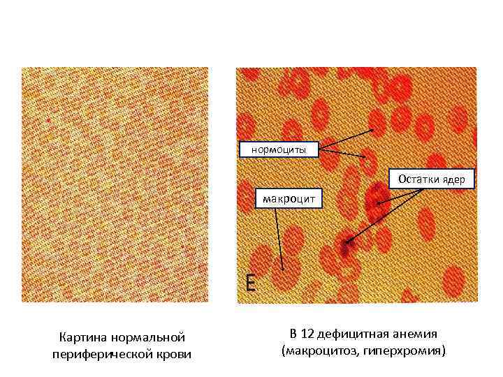 нормоциты Остатки ядер макроцит Картина нормальной периферической крови В 12 дефицитная анемия (макроцитоз, гиперхромия)